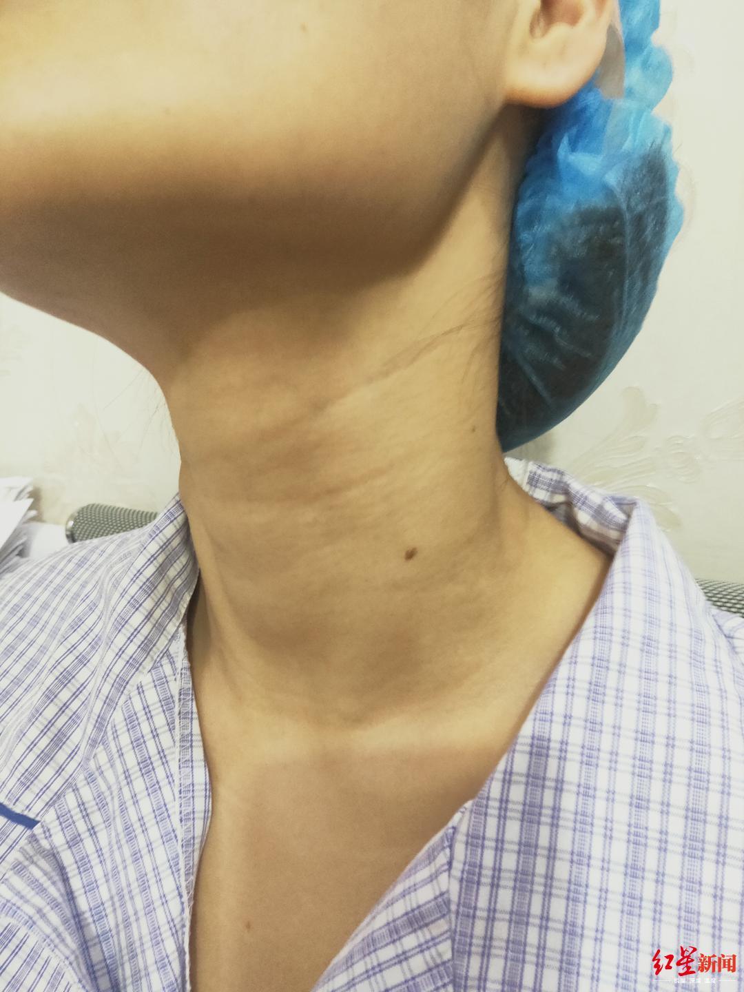 女护士命丧整形手术台 丈夫：整个脖子都是针眼